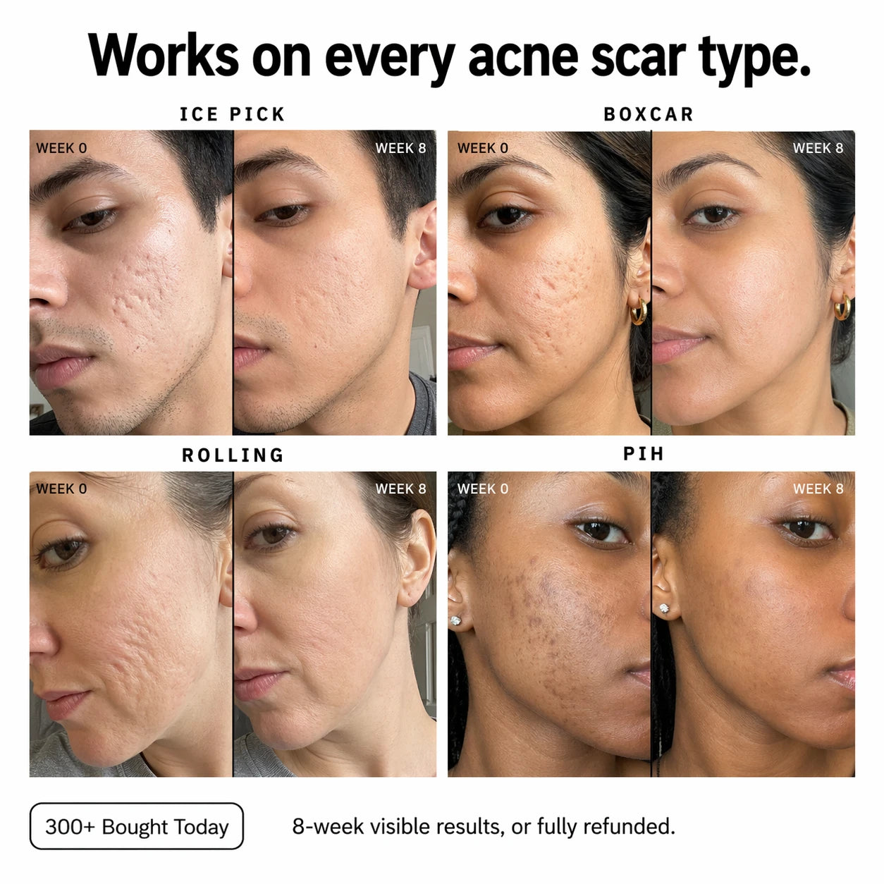 Silicone Scar Stick: Finally, A Fix That Actually Works On Acne Scars.