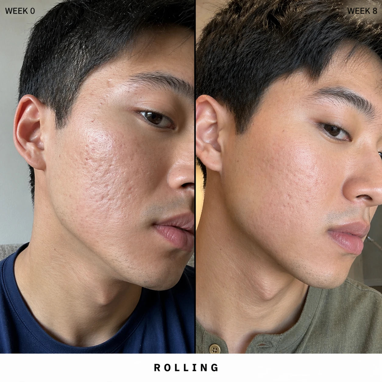 Silicone Scar Stick: Finally, A Fix That Actually Works On Acne Scars.