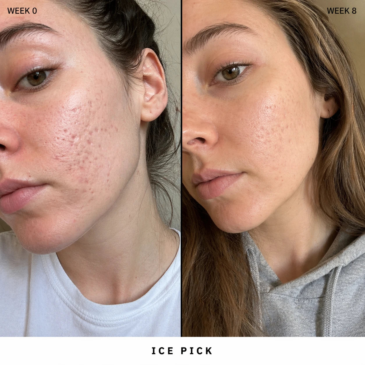 Silicone Scar Stick: Finally, A Fix That Actually Works On Acne Scars.