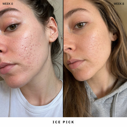 Silicone Scar Stick: Finally, A Fix That Actually Works On Acne Scars.