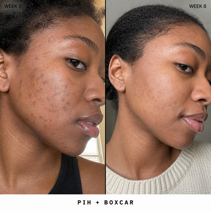 Silicone Scar Stick: Finally, A Fix That Actually Works On Acne Scars.